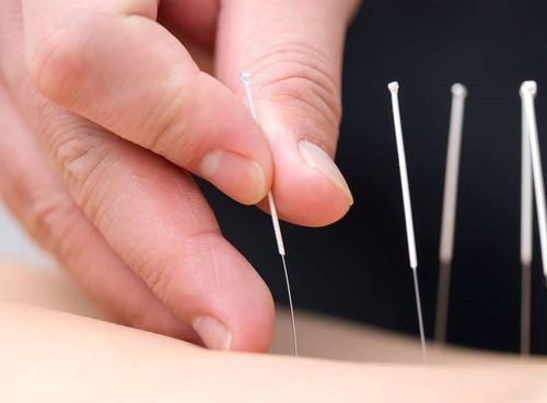Châm cứu giảm đau khớp: Tổng hợp những điều cần biết 