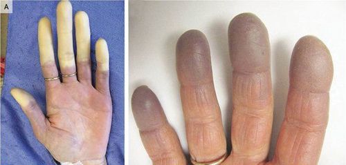 Image of hands of a person with Raynaud's disease