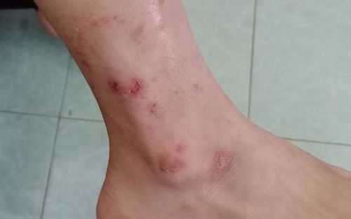 Thuốc không dùng trên vùng da bị phồng rộp hay vỡ bóng nước
