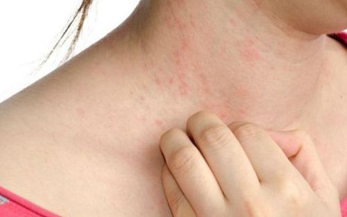 Nổi mẩn trên da được coi là một dạng phản ứng phụ khi dùng thuốc