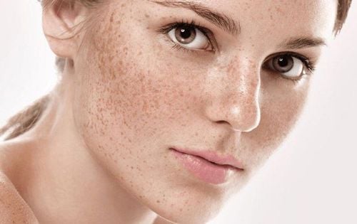 Causes of Melasma and Freckles in Puberty