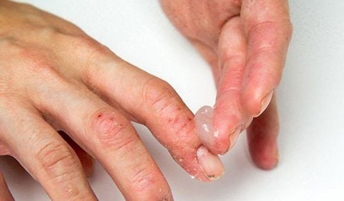 Betadine Ointment is a versatile antiseptic used for the treatment and prevention of skin infections.