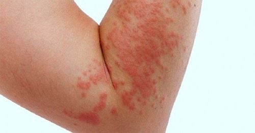 The medication may cause side effects such as skin irritation, redness, or itching at the application site.