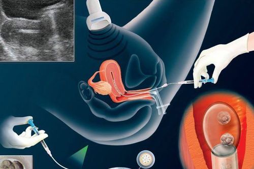 Is it normal to have brown discharge and lower back pain 6 weeks after embryo transfer?