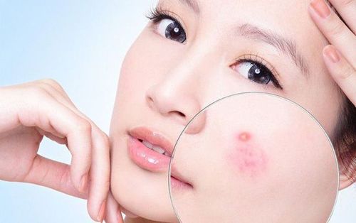 Chất chống oxy hóa trong nước ép cần tây có thể giúp cải thiện triệu chứng mụn