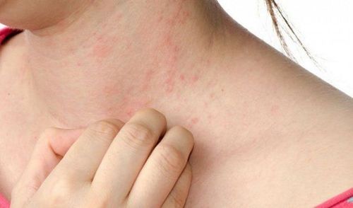 Nổi ban sau sốt siêu vi có nguy hiểm không?