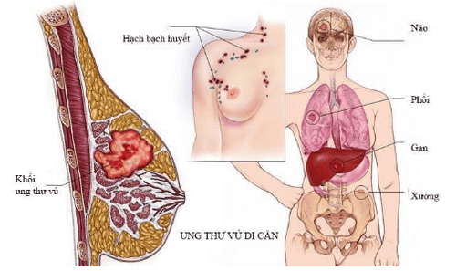 Ung thư vú có thể gây ra những biến chứng nguy hiểm