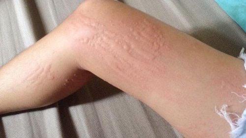Trời lạnh có thế gây ra dị ứng ở người già và trẻ nhỏ