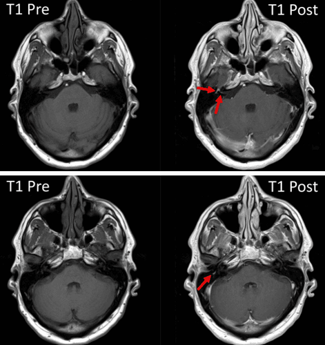 Hình ảnh MRI của bệnh nhân bị liệt dây thần kinh mặt ngoại biên cấp tính. Sự ngấm thuốc không đối xứng dọc theo dây thần kinh mặt bên phải, liên quan đến các đoạn: phần xa đoạn ngách (distal meatal), đoạn mê cung (labyrinthine), đoạn hạch gối (geniculate ganglion), đoạn nhĩ (tympanic)