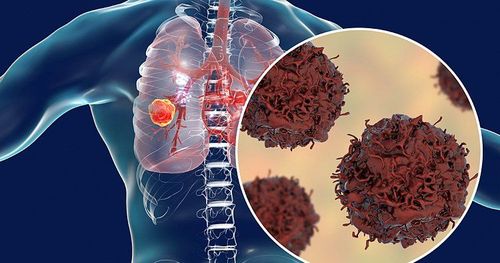 Phần lớn những người bị COPD sống sót sau 5 năm kể từ khi được chẩn đoán ung thư phổi
