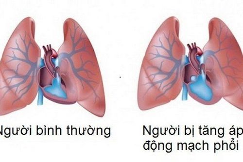Thuốc Macitentan được chỉ định dùng trong điều trị bệnh tăng huyết áp động mạch phổi.
