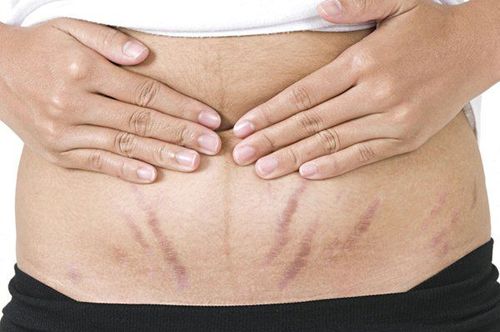 Da bụng chảy xệ sau sinh khiến chị em lo lắng