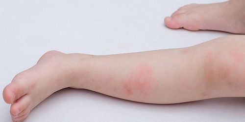 Ngứa kéo dài là dấu hiệu của bệnh gì?