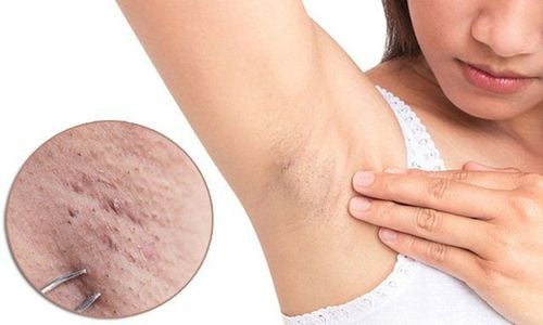 Swollen lymph nodes after plucking armpit hair can be due to a local infection.