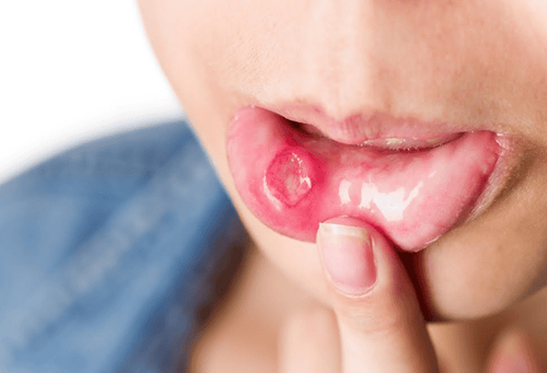Why does canker sore (aphthous stomatitis) frequently recur?  