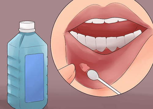 People with prolonged canker sores need treatment according to doctor's instructions.
