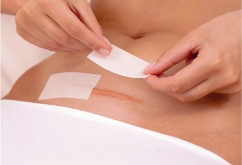 Nhức vết mổ sau sinh có sao không?
