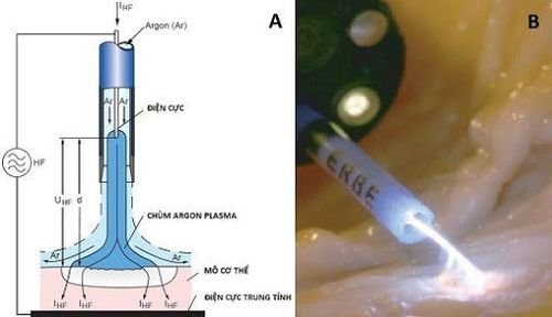 Cầm máu ống tiêu hóa bằng laser argon plasma ít gây tai biến