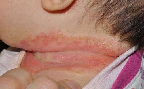 Bệnh hồng ban đa dạng có nguy hiểm không?