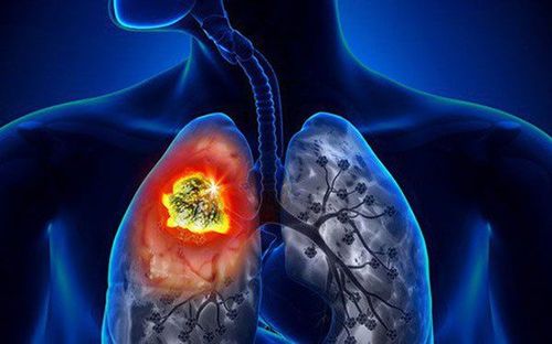 Thông thường các bác sĩ sẽ cần xác định mức độ nghiêm trọng của bệnh ung thư phổi, được gọi là giai đoạn