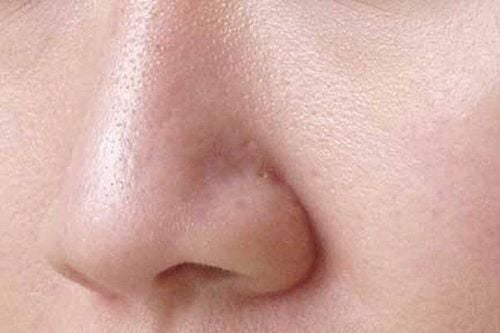 Sebaceous filaments appear due to the disordered activity of sebaceous glands on the skin.