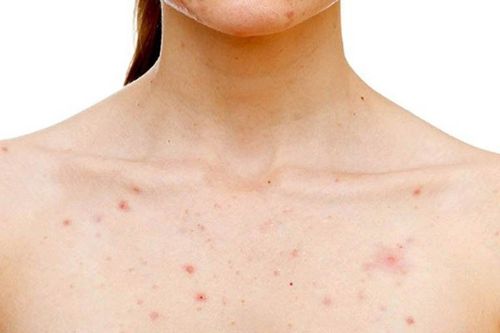 How to handle Clogged Hair Follicles?