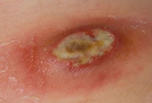 Suppurative wounds caused by inadequate cleaning and improper care may lead to infection.