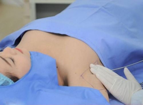 Armpit liposuction must be performed with precision and care.