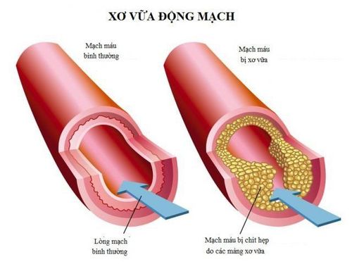 
Virut viêm gan C cũng có thể gây ra xơ vữa động mạch
