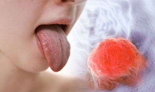 Phẫu thuật cắt đáy lưỡi được chỉ định với bệnh nhân ung thư đáy lưỡi nhỏ và vừa