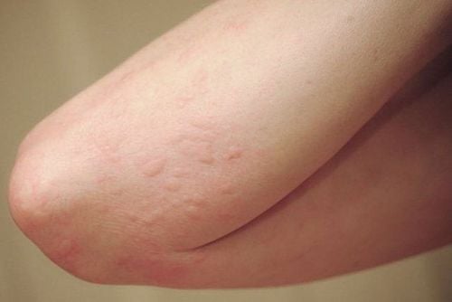 An allergic reaction is one of the causes of itchy skin.