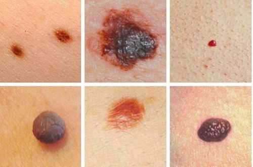 Different Types of Moles