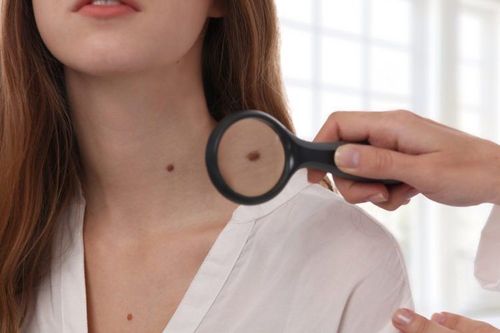 Be proactive about checking for moles when you see something unusual