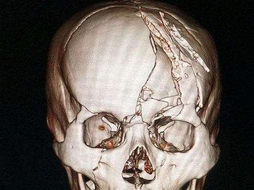 
Trong trường hợp bệnh nhân lún xương sọ không đủ điều kiện để bảo tồn, bác sĩ sẽ chỉ định phẫu thuật
