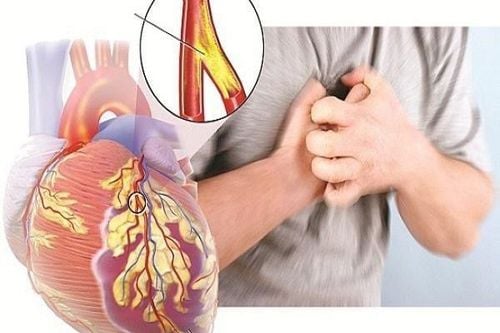 
Bệnh lý hẹp động mạch vành là một trong các nguyên nhân gây đau thắt ngực
