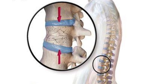 Nữ giới xẹp 3 đốt cột sống điều trị như thế nào?