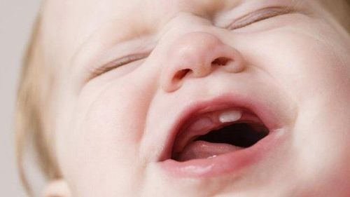 Răng sữa mọc thiếu xảy ra với tỉ lệ thấp, thường không có triệu chứng