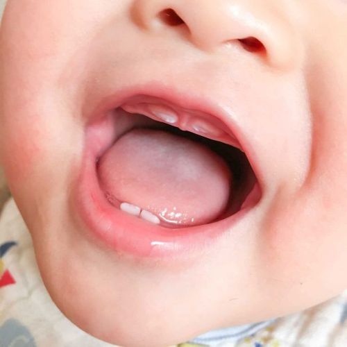 Răng sữa mọc thiếu ở trẻ em có thể là kết quả của các rối loạn bẩm sinh