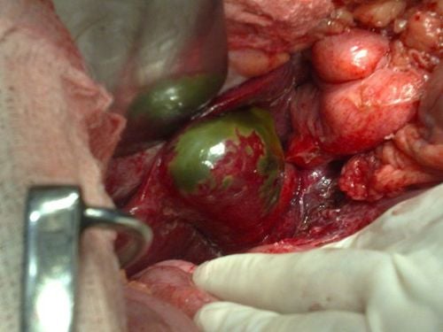 Image of necrotizing cholecystitis in patients.