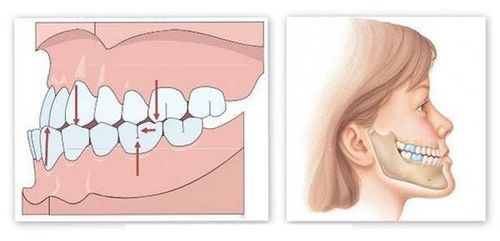 Trường hợp trẻ hay nghiến răng có thể do khớp cắn bị lệch