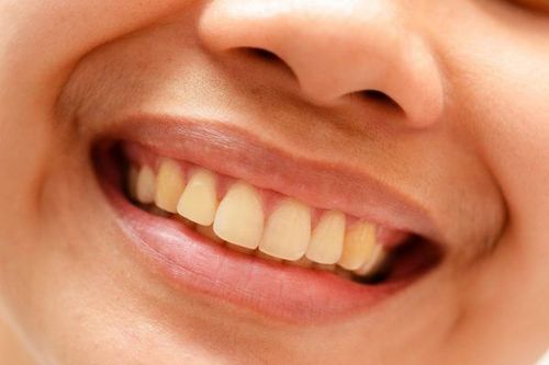 Một số tình trạng bệnh có thể khiến răng bạn bị ố và cần làm trắng răng tại nhà
