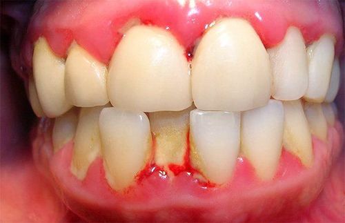 
Viêm nha chu khiến nướu răng chảy máu
