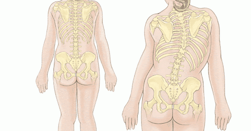 Điều trị vẹo cột sống ở bé gái 15 tuổi như thế nào?