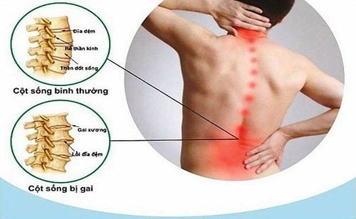 Thuốc giảm đau gai cột sống có thể giúp người bệnh cải thiện một số triệu chứng đau