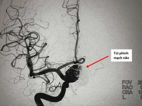Ca bệnh thứ 1 – Tình trạng túi phình trước khi đặt stent.