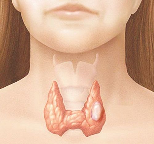 Nhân giáp thùy trái TIRADS 3 có nguy cơ mắc ung thư không?