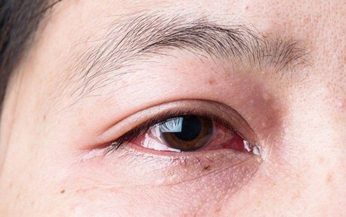 
Bệnh lý viêm kết mạc có thể khiến bạn gặp tình trạng chảy nước mắt
