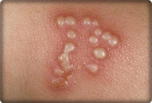 Genital herpes is one of the common types of genital warts.
