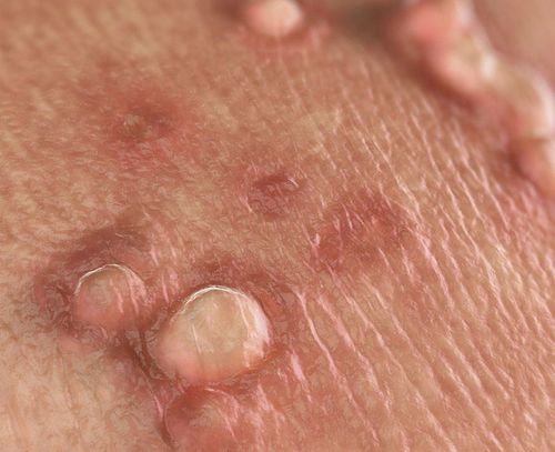 Uses Of Podophyllin Vinmec Uses Of Podophyllin Vinmec