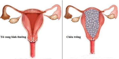 Thai trứng có thể dẫn đến ung thư nhau thai